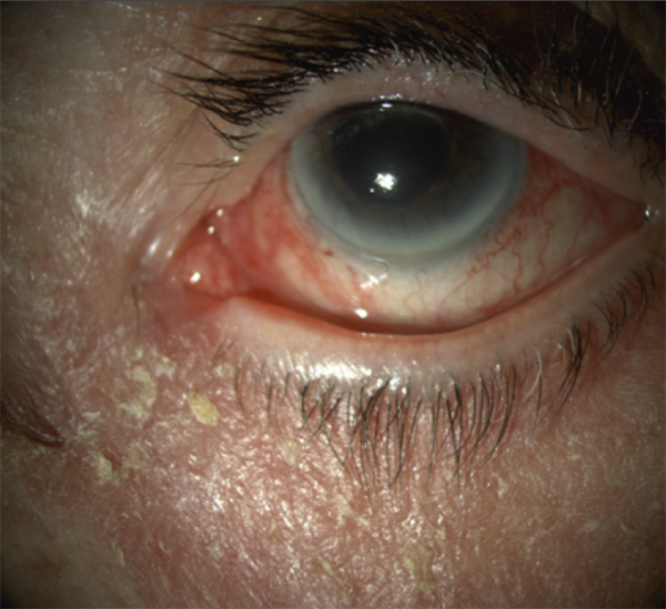 roaccutane 40mg