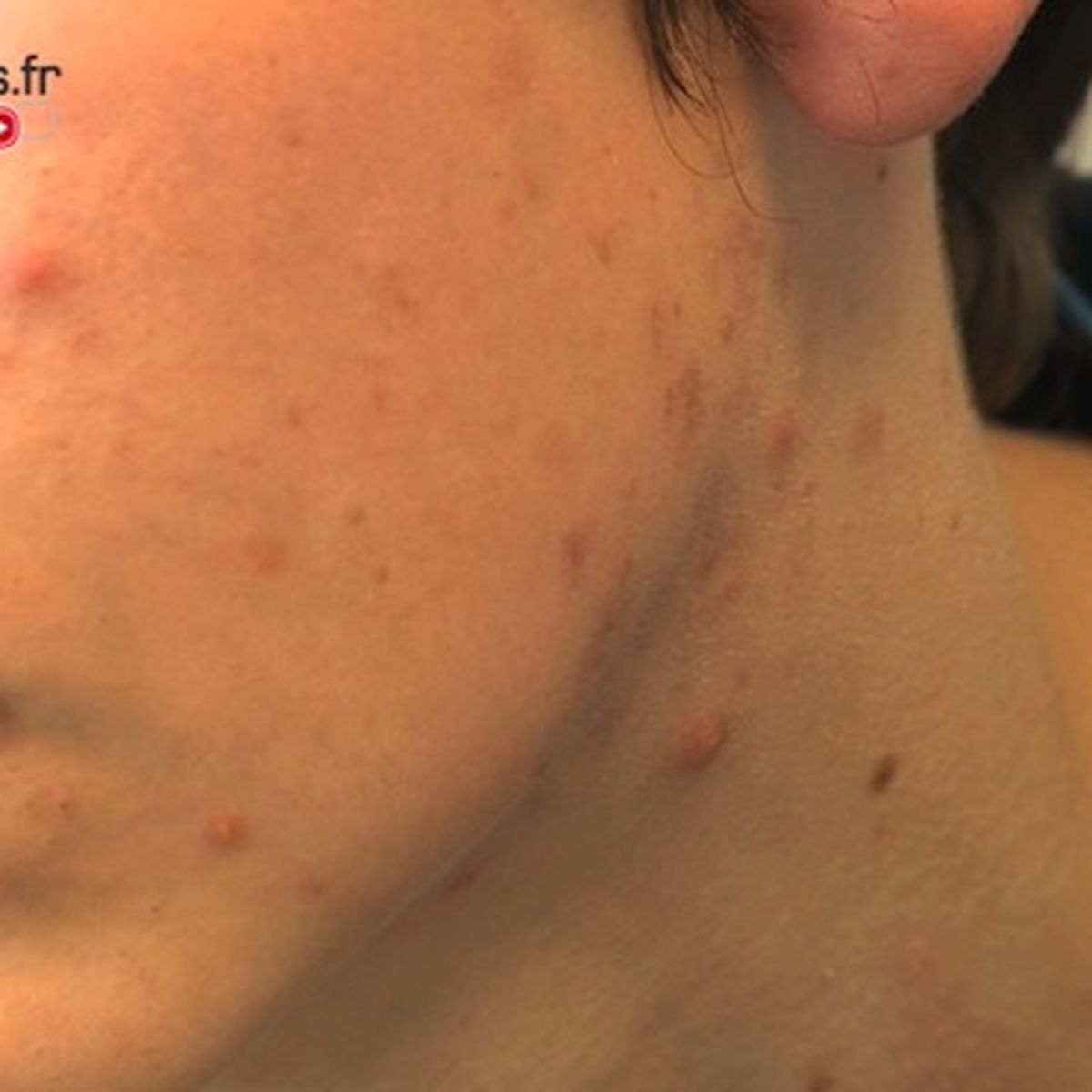 Roaccutane Bnf Online
