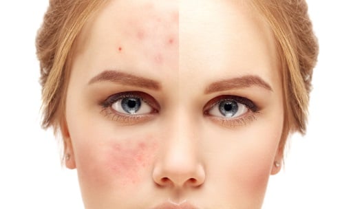 Roaccutane Bon Marché