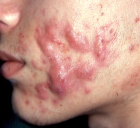 Roaccutane comment acheter