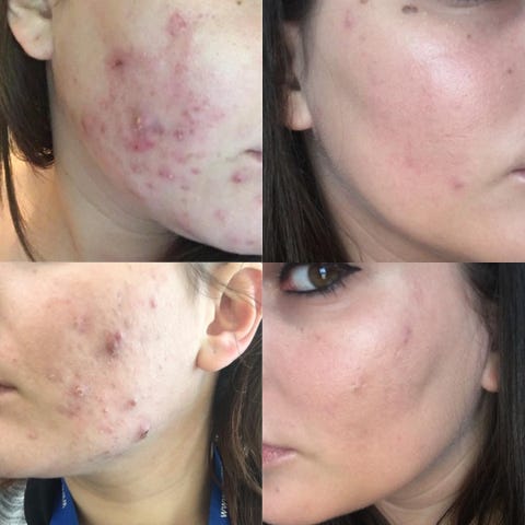 Roaccutane de 10 mg