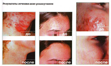 roaccutane france