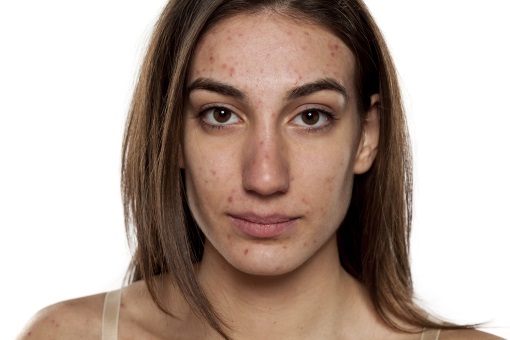 Roaccutane Gel Achat En Ligne