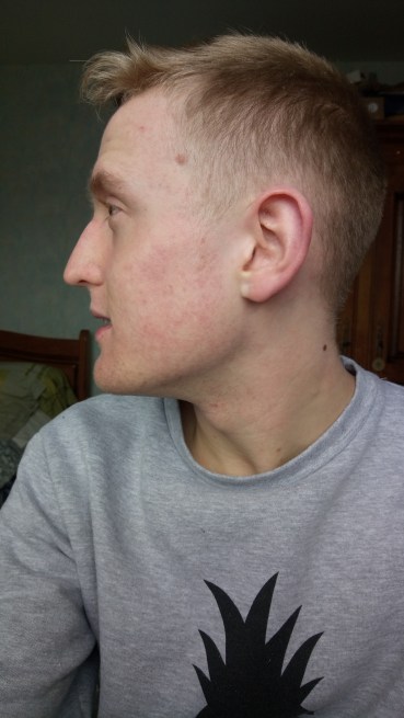 Roaccutane Le Moins Cher