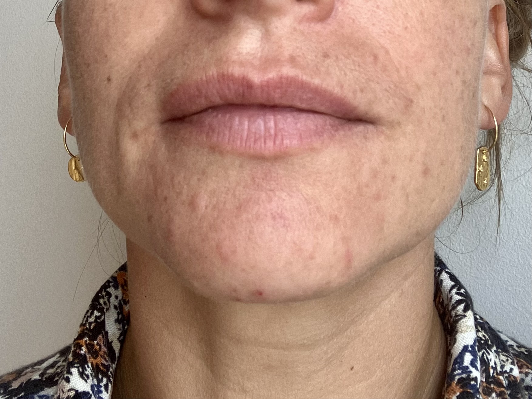 Roaccutane pharmacie en ligne