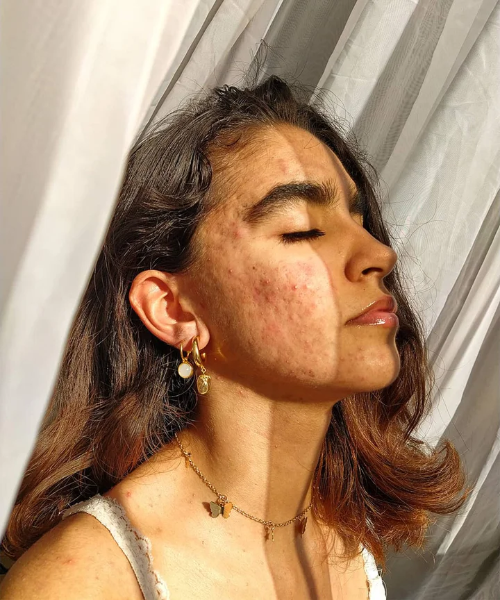 Roaccutane pilule du lendemain