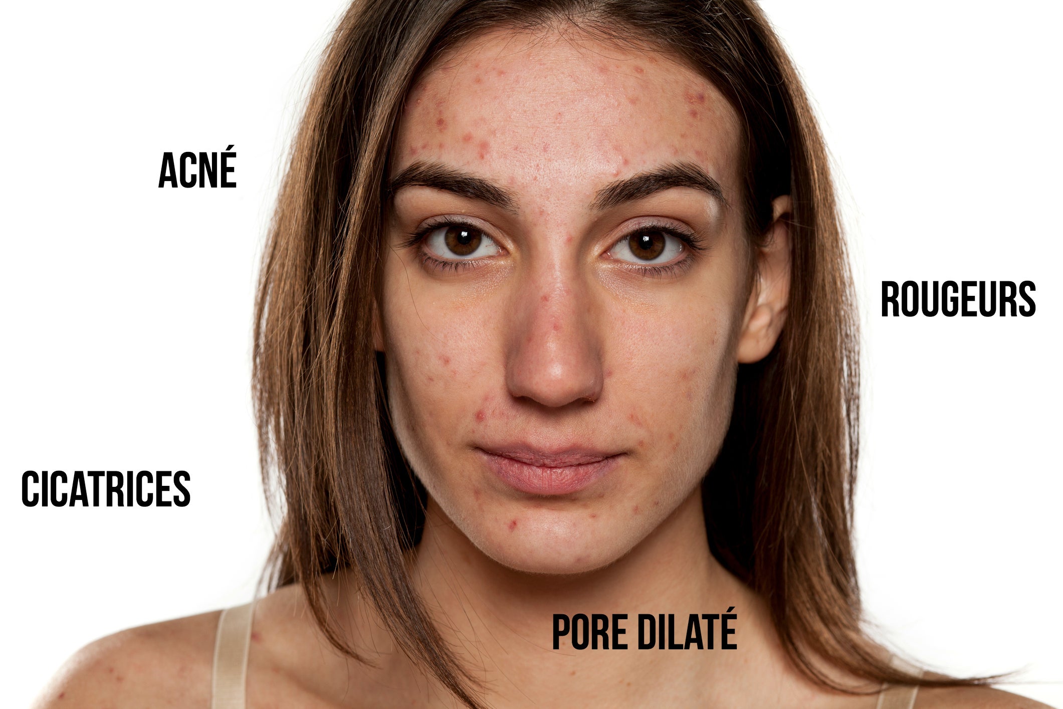 roaccutane sans contraception