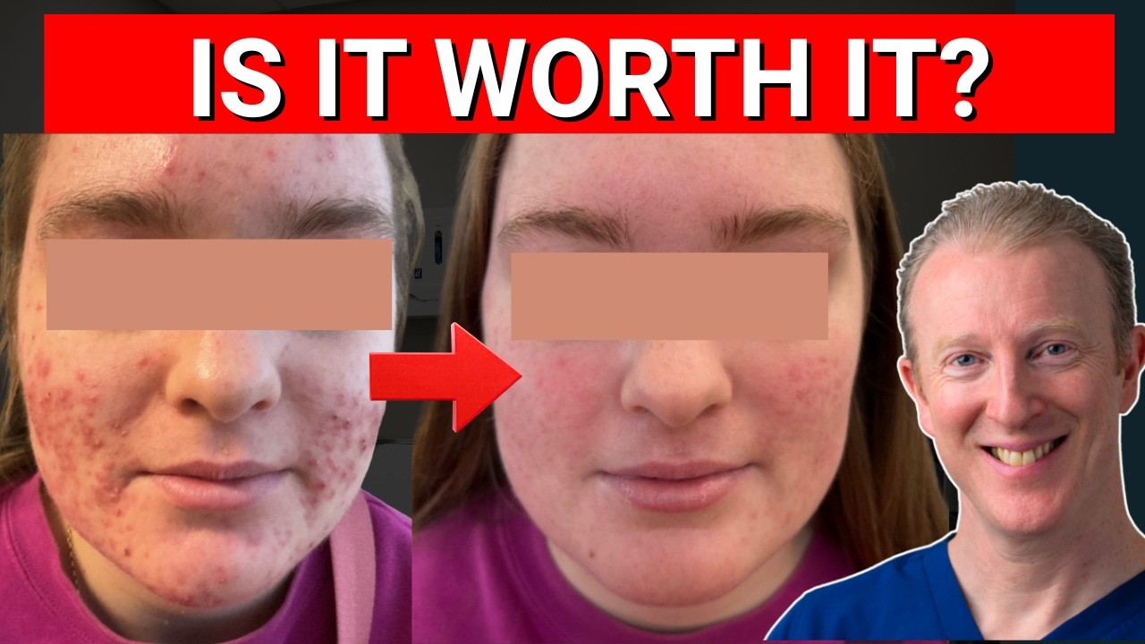 Roaccutane Sans Contraception