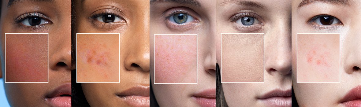 roaccutane sans ordonnance